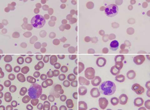 Leucemia Linfocítica Crónica (LLC)